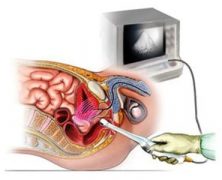 endoanal-ultrasound